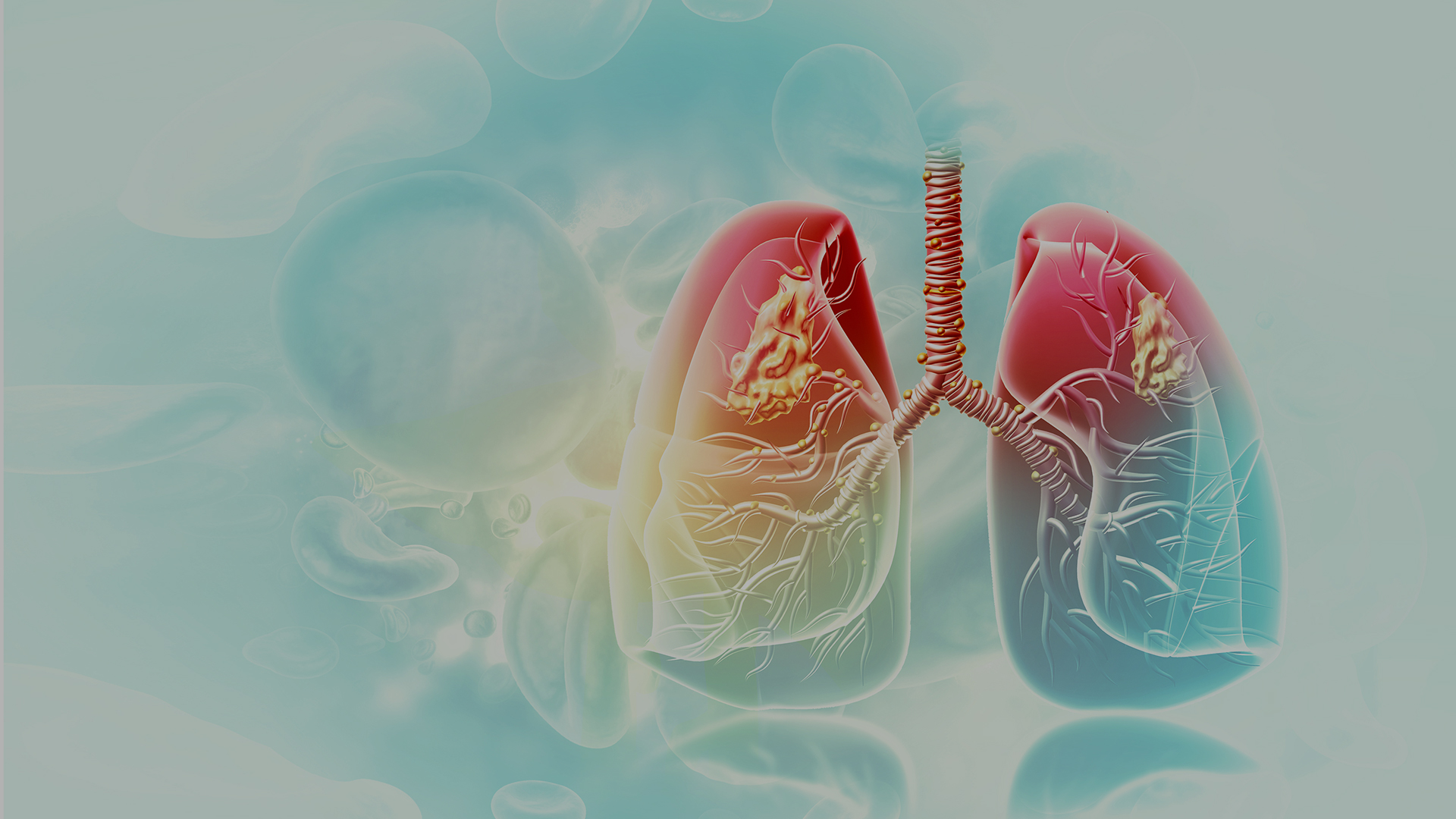 EPIGENETIC IMPRINTING BIOMARKERS IN LUNG NODULES